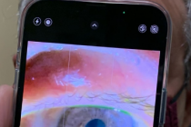 一位医生正在使用iPhone13ProMax的微距模式检查患者的眼睛