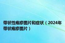 带状性疱疹图片和症状（2024年带状疱疹图片）