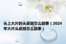 头上大片的头皮屑怎么回事（2024年大片头皮屑怎么回事）